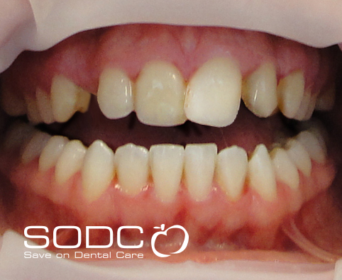 Metal free E-max veneers, dental implant. before