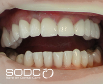 Metal free E-max pressed ceramic veneers whitening after