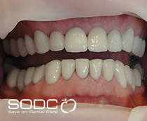 Porcelain bonded crowns after