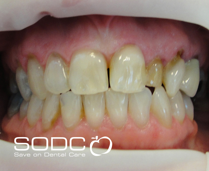 Porcelain crown and tooth whitneing. after
