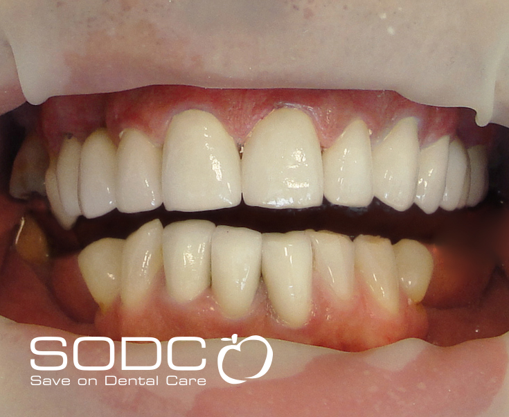 Zirconium crowns. after