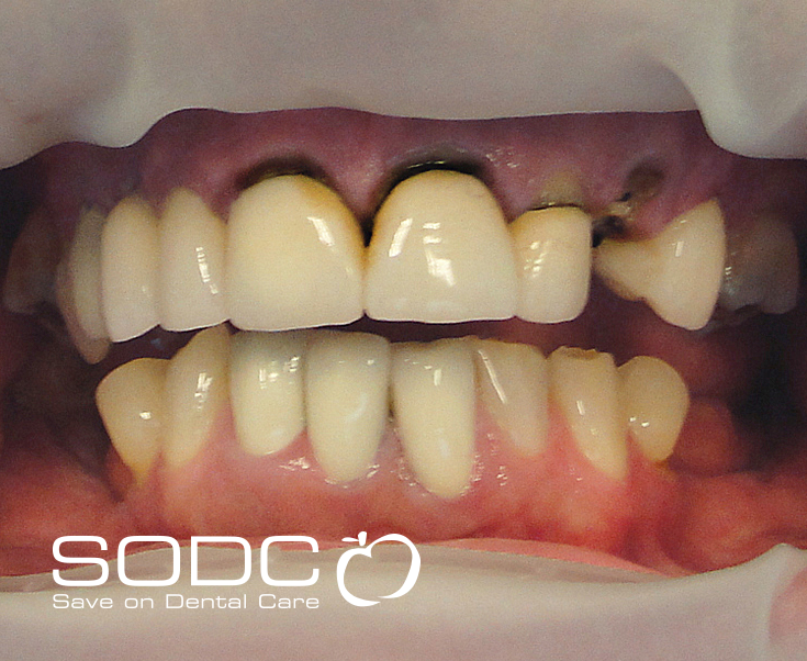 Zirconium crowns. before