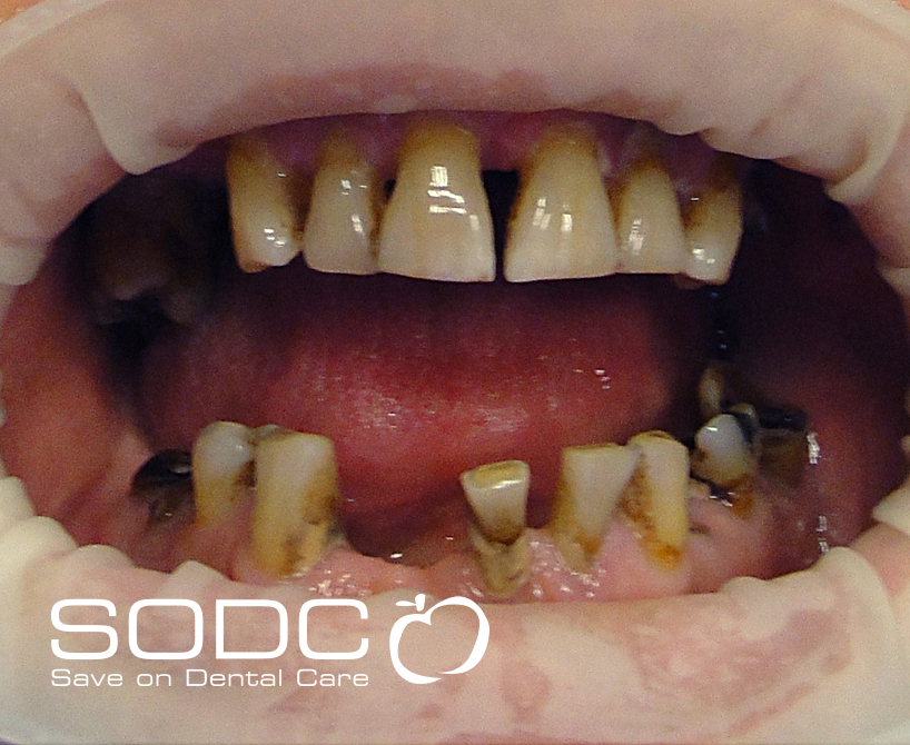 Dental implants, porcelain crown, and bridge after