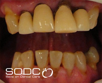  Fixed denture with implants after