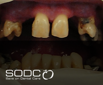 Fixed denture with implants before